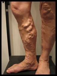 Volumineuses varices de jambe