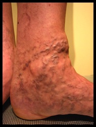 Veines inesthétiques pieds